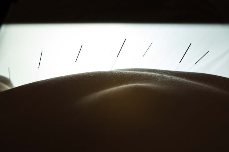 5 Point Acupuncture clinic